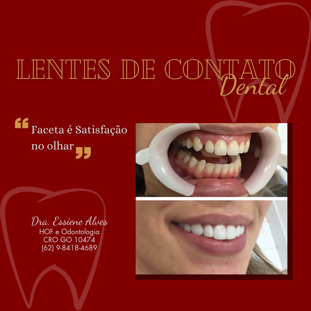 FACETAS PORCELANA GOIANIA GOIAS